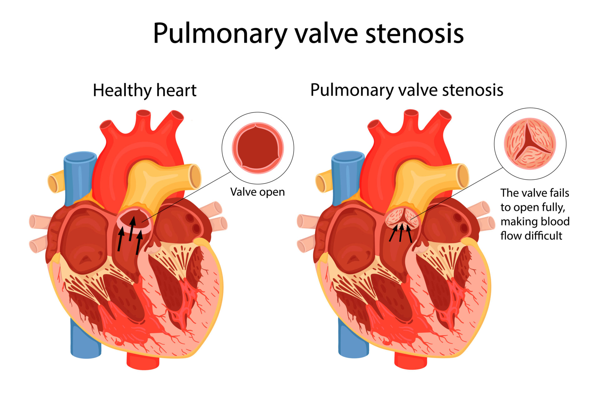 pulmonary valve stenosis. anatomical illustration