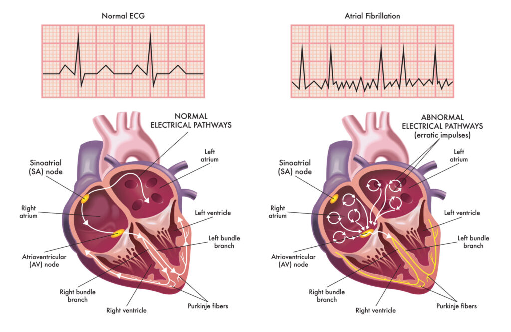 Medical illustration showing the symptoms of a heart with atrial fibrillation compared to normal one.