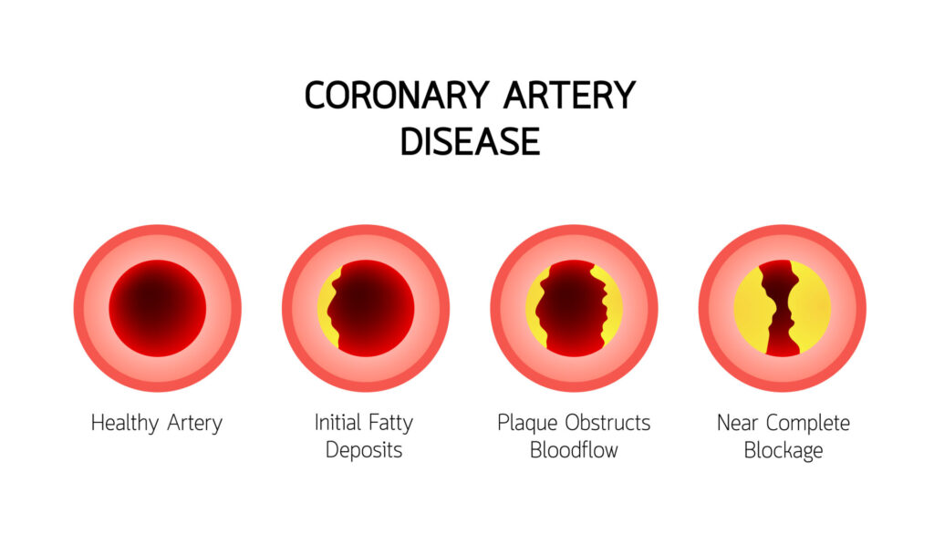Coronary Artery Disease infographic. Heart awareness concept. Atherosclerosis stages in artery caused by cholesterol plaque. Vector illustration isolated on white background.